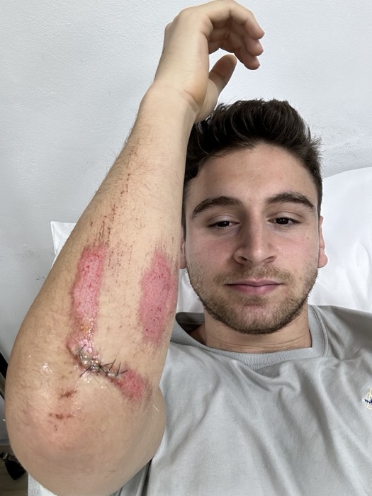 Joshua: hospital selfie showing stitched, grazed arm injury